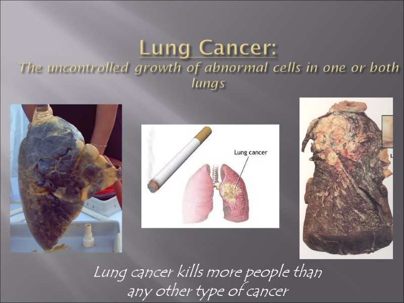 Lung Cancer: The uncontrolled growth of abnormal cells in one or both lungs Lung